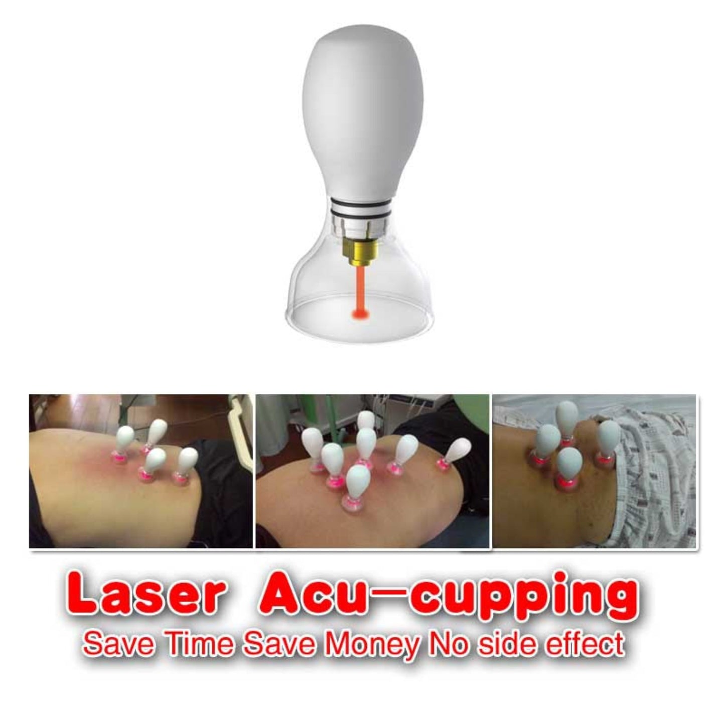 Ventouses par acupuncture au laser 