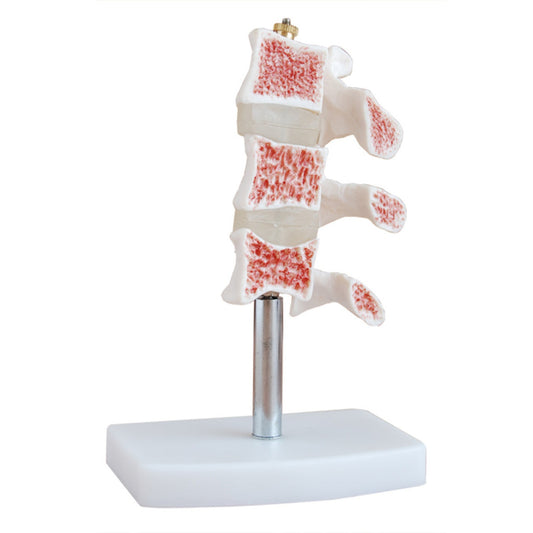Cutaway Osteoporosis
